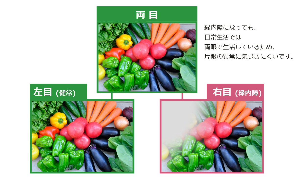 緑内障 日本アルコン株式会社