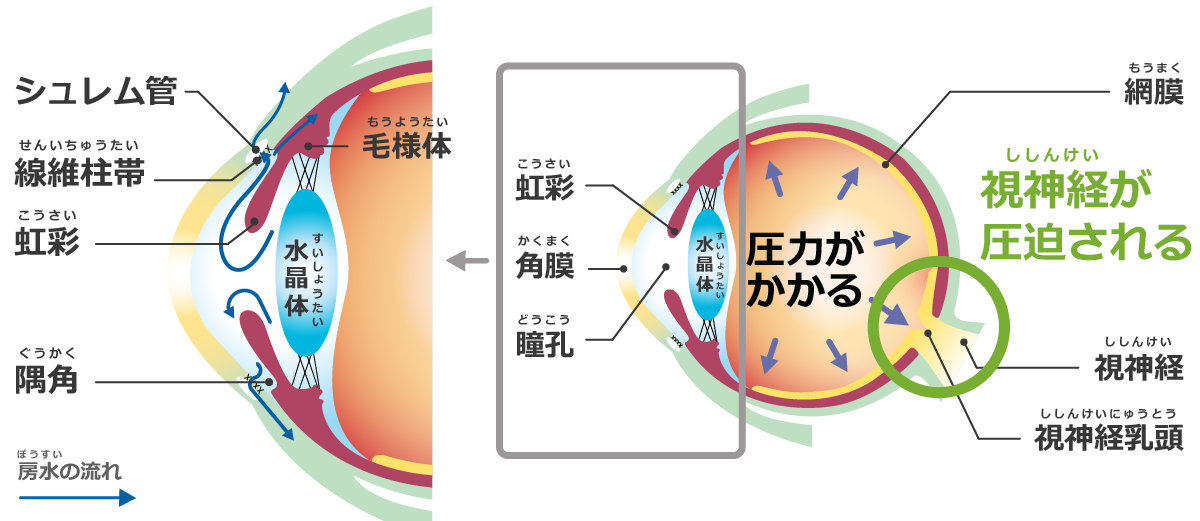 が 高い 圧 眼